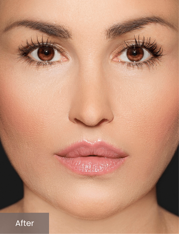 After Image: Dermal Fillers case - front