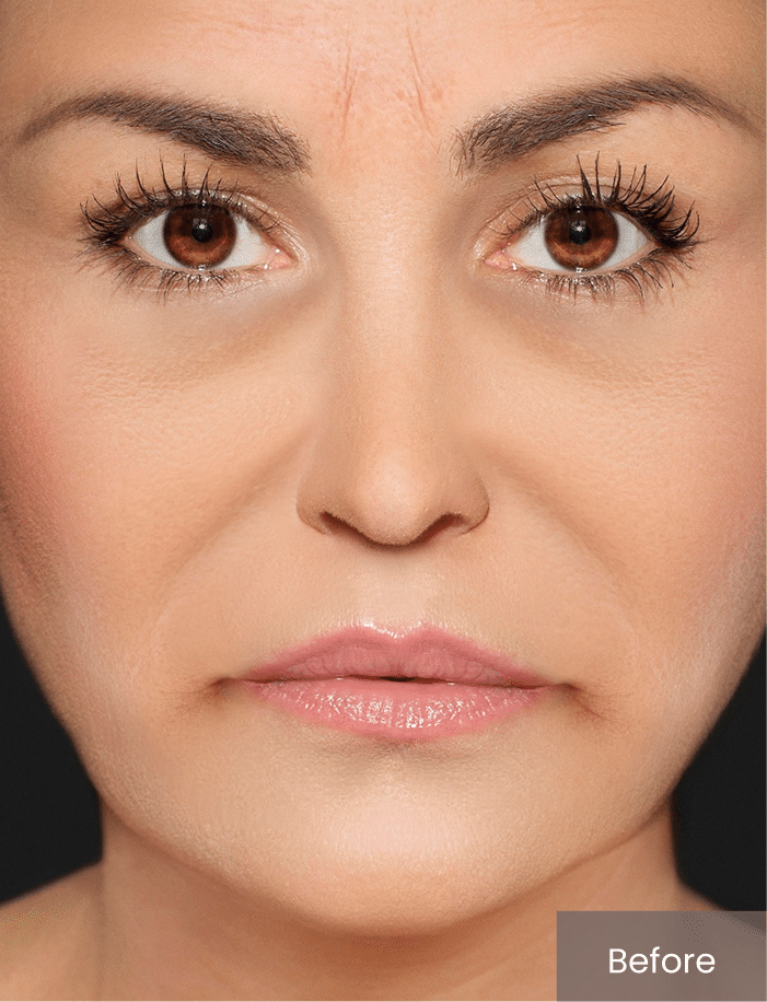 Before Image: Dermal Fillers case - front