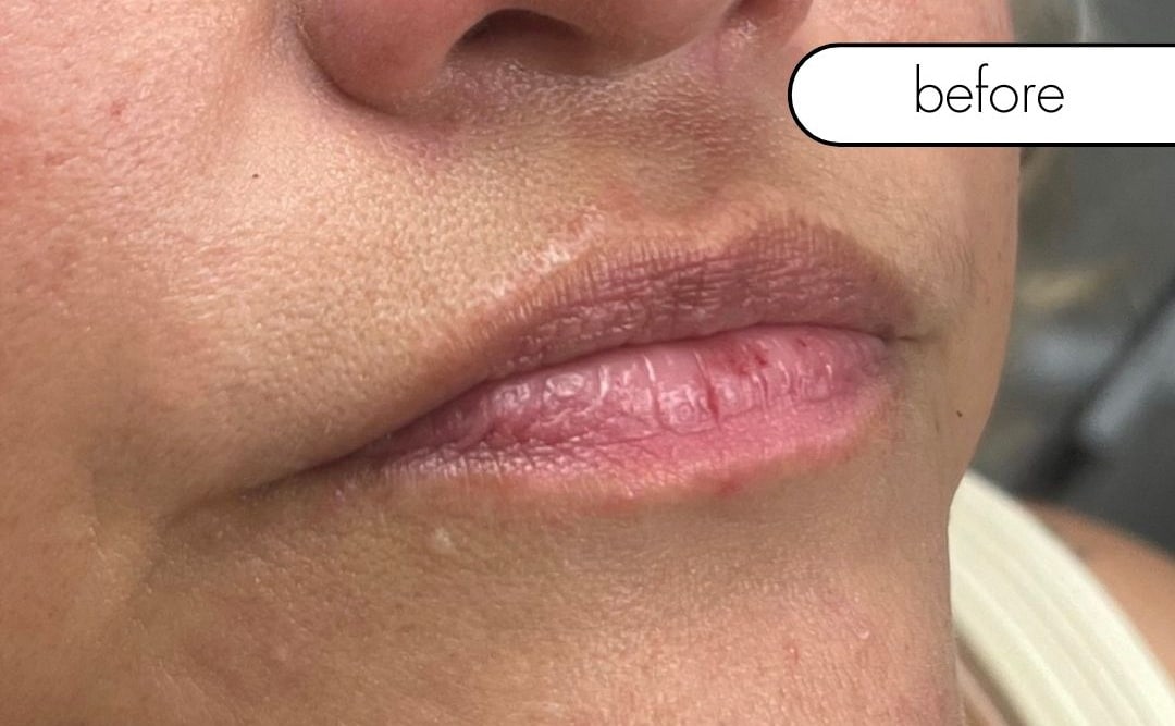 Before Image: Lip Filler - right-front-oblique