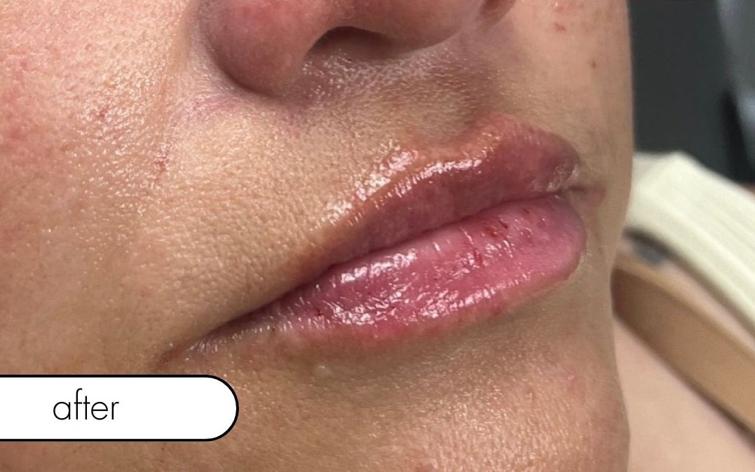 After Image: Lip Filler - right-front-oblique