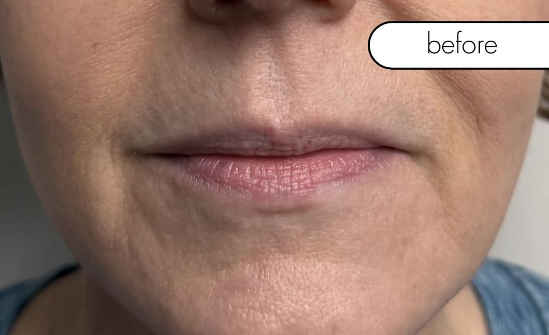 Before Image: Lip Filler - front