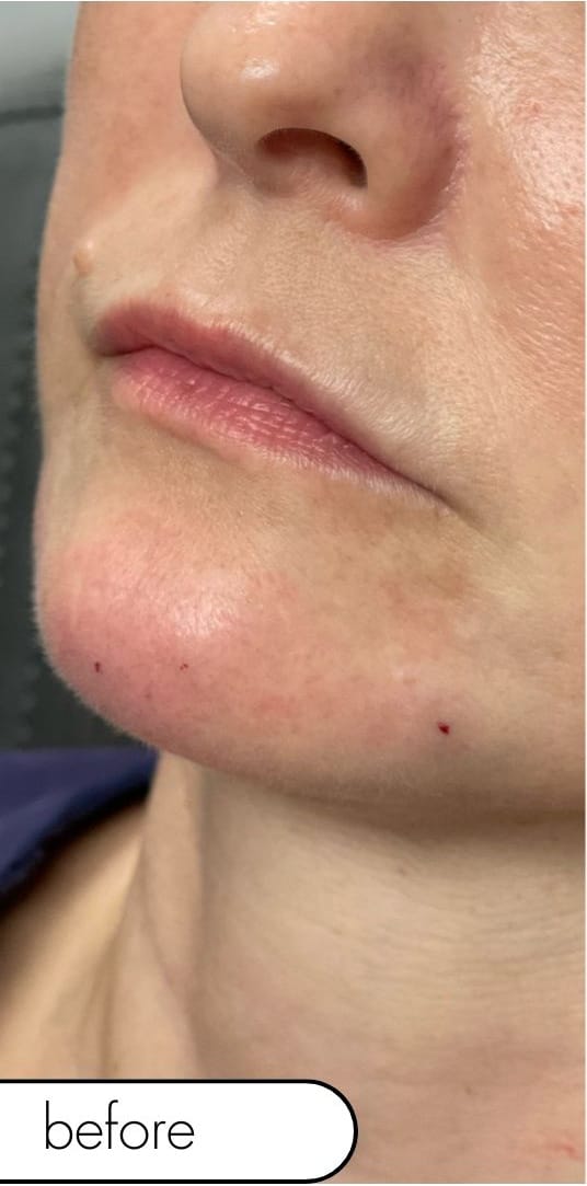 Before Image: Lip and Chin Filler - front