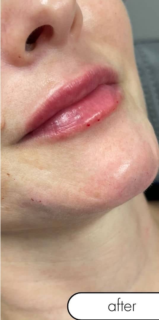 After Image: Lip and Chin Filler - front