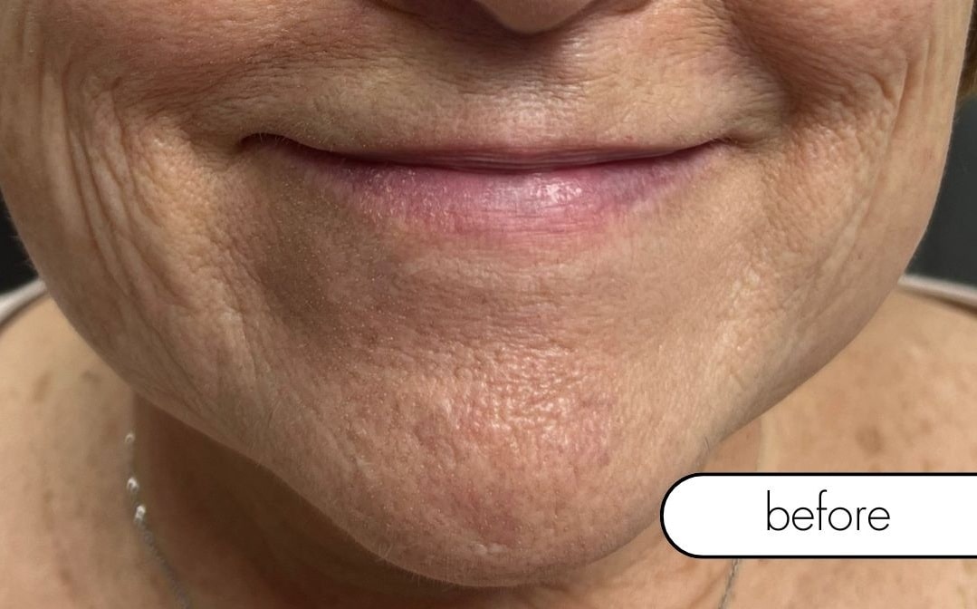 Before Image: Smile Line Filler - front