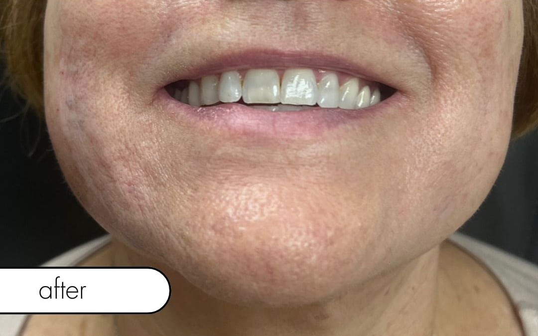 After Image: Smile Line Filler - front
