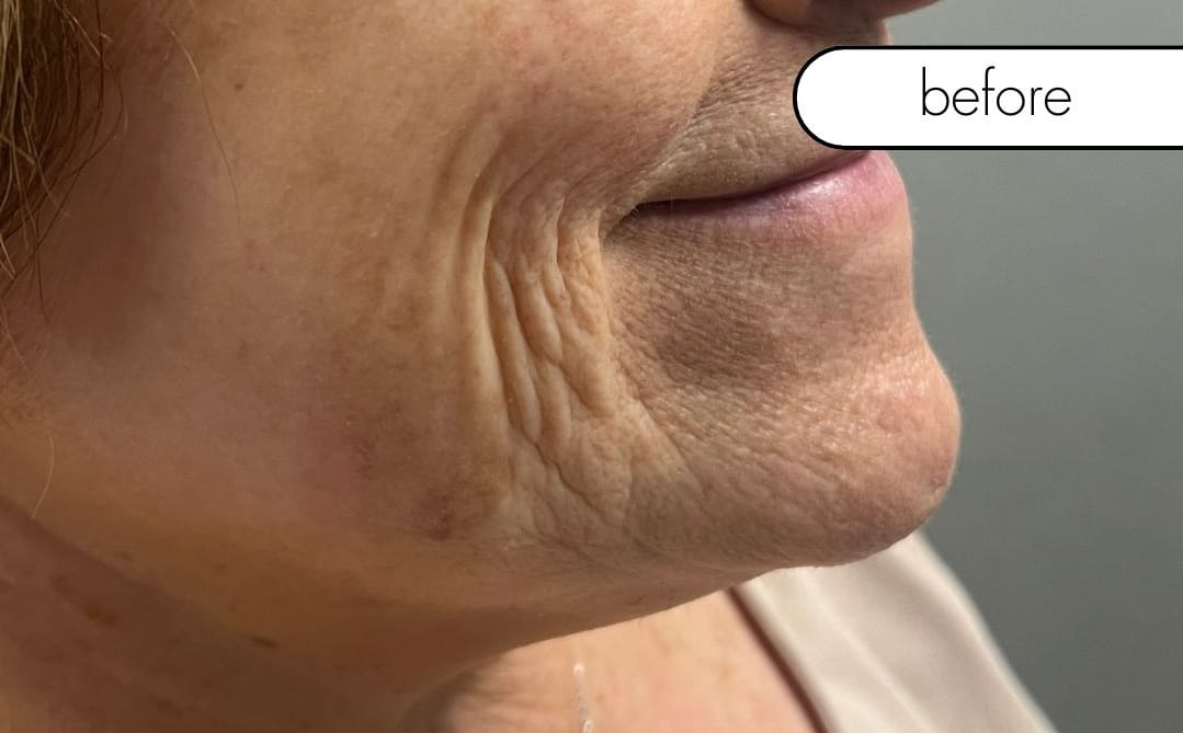 Before Image: Smile Line Filler - right-side