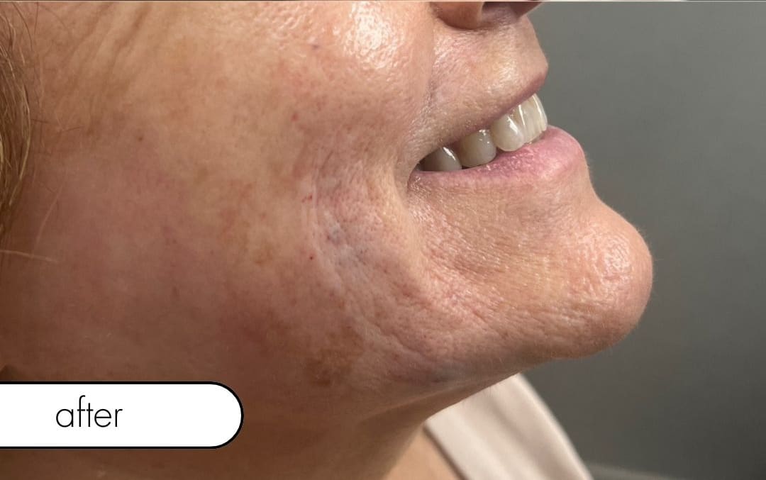 After Image: Smile Line Filler - right-side