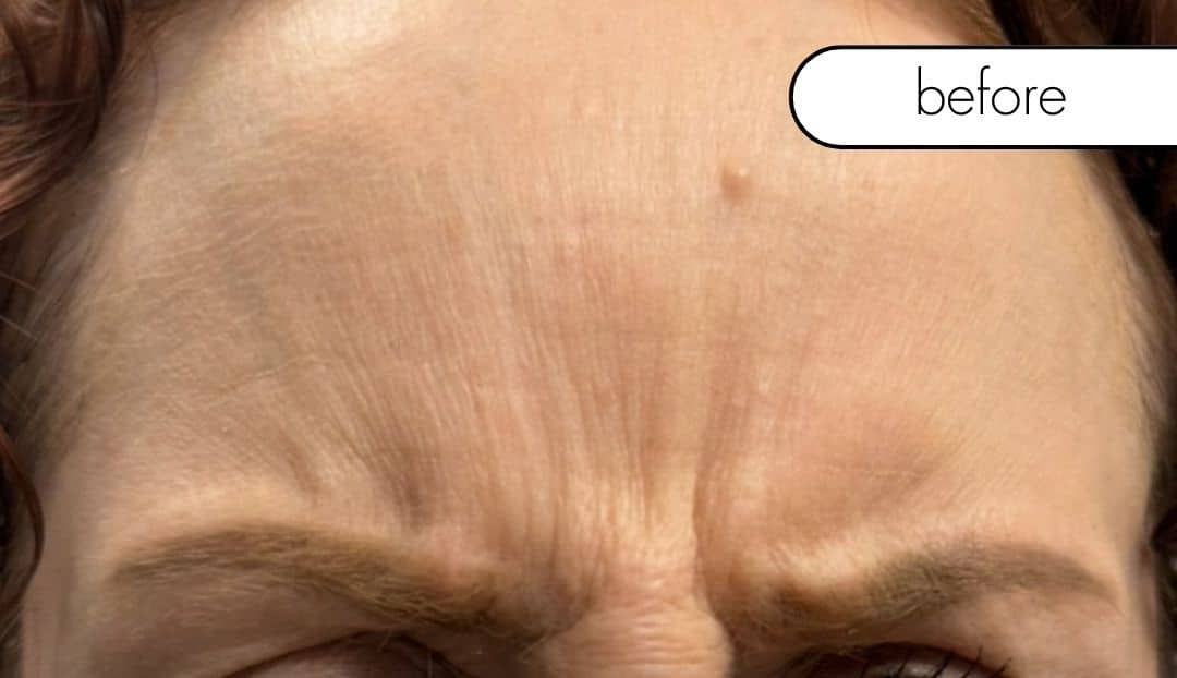 Before Image: Wrinkle Relaxer - front